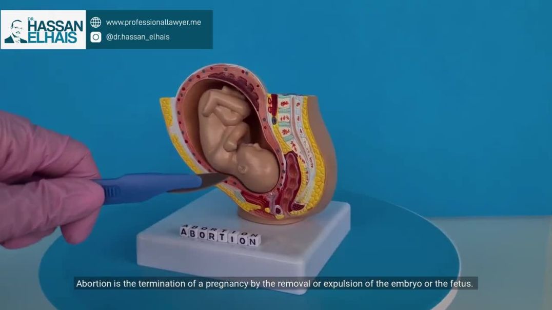 Abortion Law in UAE 2025 Legal Status &amp;amp; Rules You Must Know